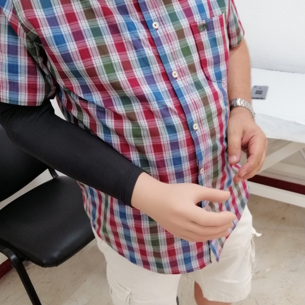 protesi-amputazione-braccio